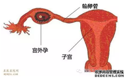 泰安拜城县宫外孕的注意事项有哪些