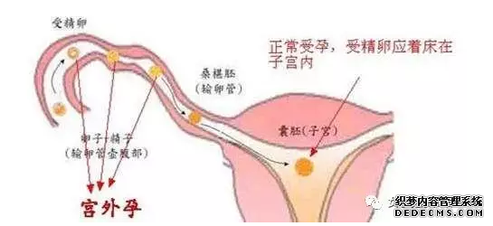 泰安新和县宫外孕的早期症状有哪些呢