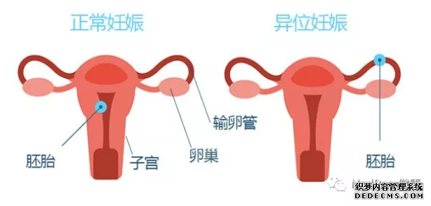 阿拉尔市怀孕早期哪些征兆可以看出是宫外孕